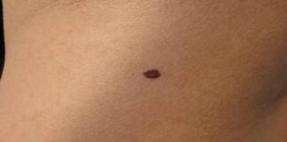 शरीर के इन अंगों के तिल माने जाते हैं बहुत अशुभ, शादीशुदा जिंदगी पर पड़ता है बहुत बुरा असर Moles On Body