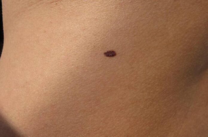 Moles On Body