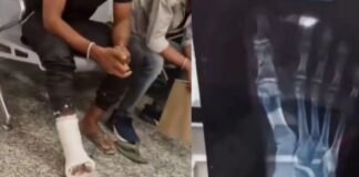 गजब का इलाज! टूटा था सिर्फ पैर का अंगूठा, डॉक्टर ने पूरे पैर को बना दिया ‘मम्मी’, वायरल वीडियो देख चकरा जाएगा सिर अंगूठा